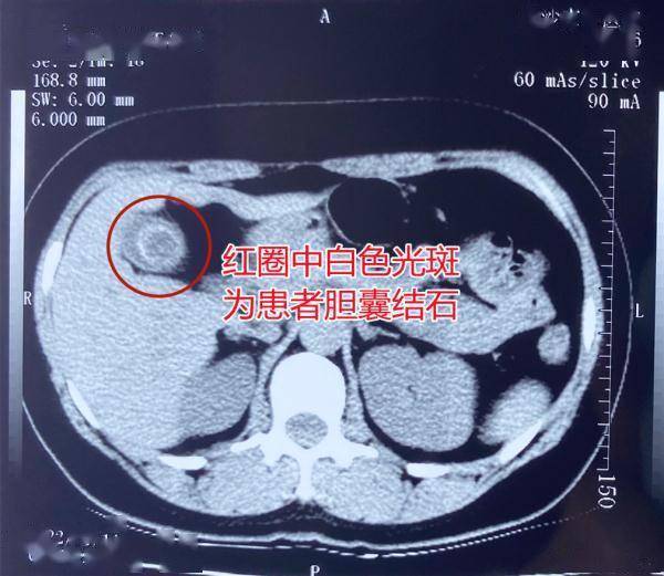 女子腹痛5年以为是胃病，入院检查结果让她意外 (图1)